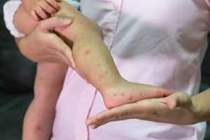 Amid measles outbreak, health care professionals step up